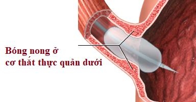 Không nuốt được vì chứng co thắt thực quản